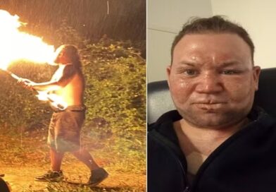 Cuspidor de fogo amador sofre acidente durante churrasco e acaba queimado: ‘Meu rosto derreteu’
